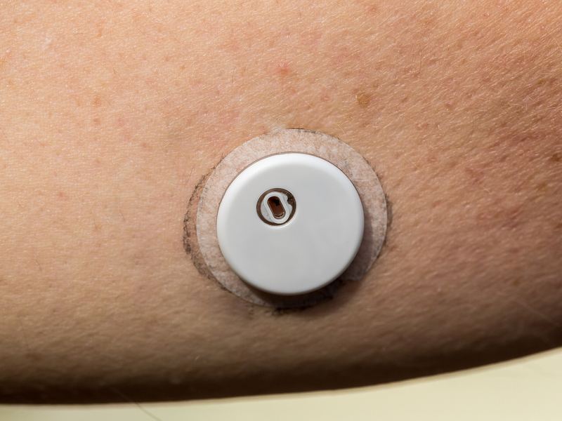 A FreeStyle Libre 3 glucose sensor worn on the upper arm